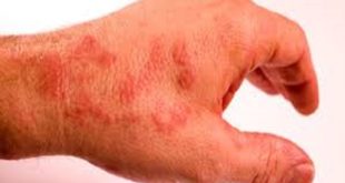 Legnostorto: Dermatite atopica, il maggior numero di pazienti è in Italia?